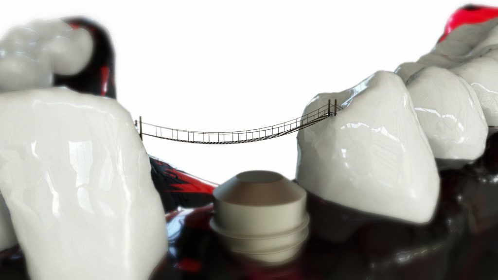 dental bridge